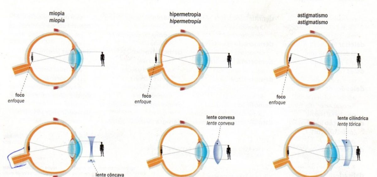 Hipermetropía y astigmatismo - Miopia
